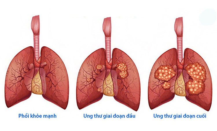 Ung thư phổi 1 Ung thư phổi 1