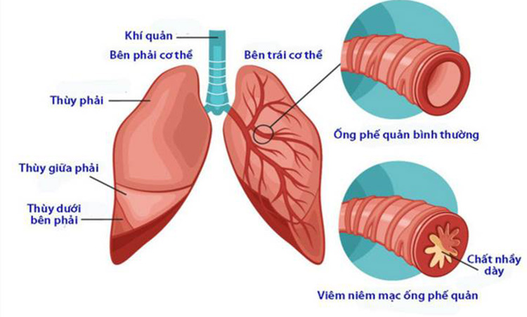 Viêm phế quản 1 Viêm phế quản 1