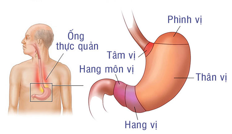 9. Bệnh hẹp hang vị dạ dày 1 9. Bệnh hẹp hang vị dạ dày 1