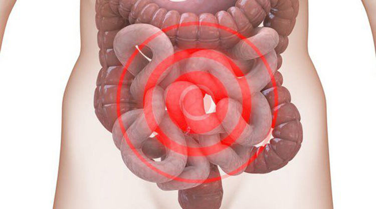 4. Hội chứng ruột kích thích 1