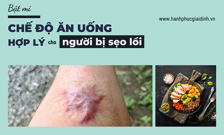 Bật mí chế độ ăn uống cho người bị sẹo lồi 1 Chế độ ăn cho người bị sẹo lồi
