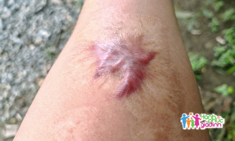 Có rất nhiều nguyên nhân gây sẹo lồi cho bạn