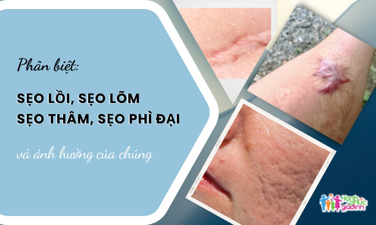 Phân biệt: sẹo lồi, sẹo lõm, sẹo thâm, sẹo phì đại và ảnh hưởng của chúng 1 Phân biệt sẹo lồi, sẹo lõm, sẹo phì đại, sẹo thâm