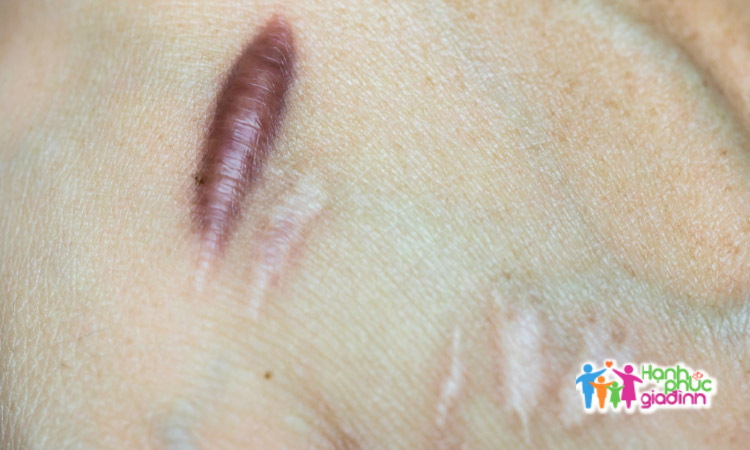 Sẹo lồi 1 Hình ảnh sẹo lồi