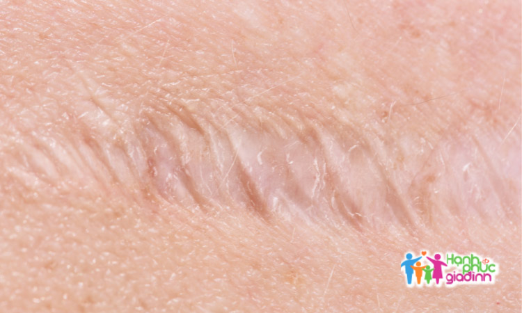 Sẹo lõm 1 Sẹo lõm