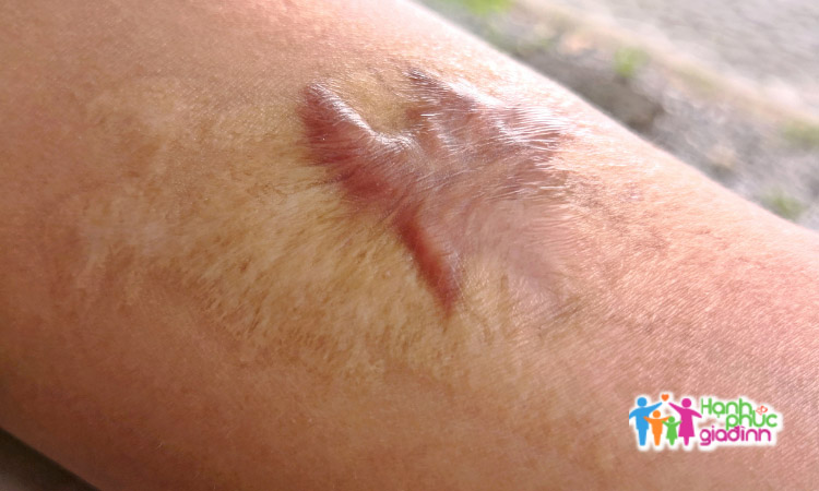 Sẹo phì đại 1 Sẹo phì đại