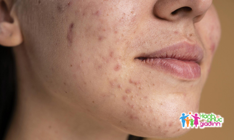 Sẹo thâm 1 Sẹo thâm