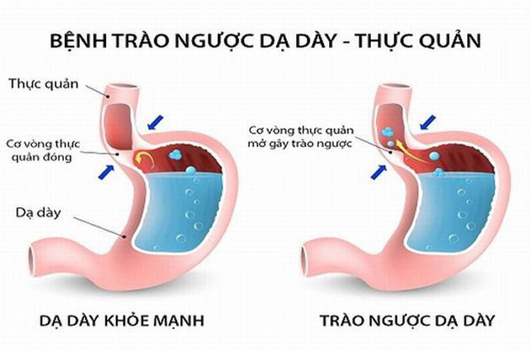 Trào ngược dạ dày thực quản 1 Trào ngược dạ dày thực quản 1