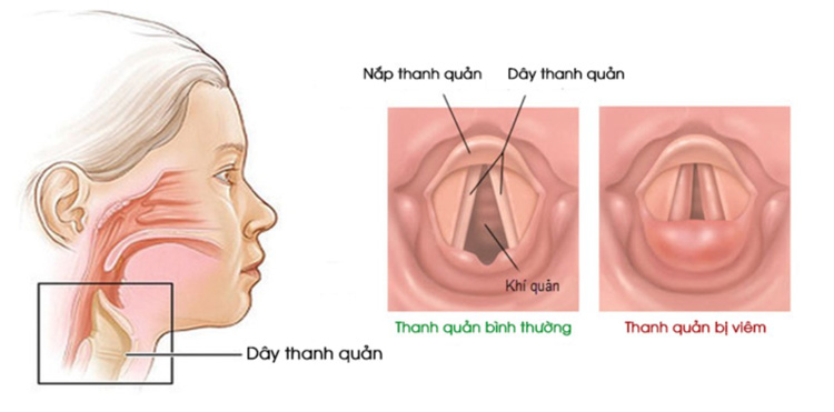 Viêm thanh quản 1 Viêm thanh quản 1