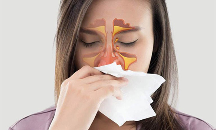 Viêm xoang 1 Viêm xoang 1