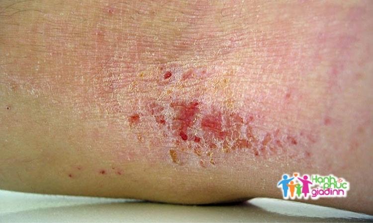 Chàm bội nhiễm là gì