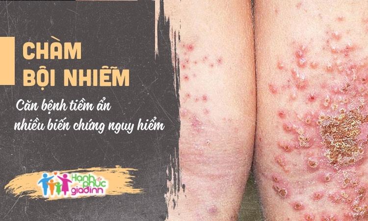 Cham bội nhiễm biến chứng nguy hiểm