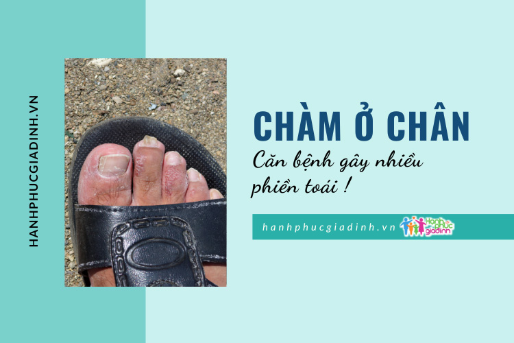 Chàm da chân là gì làm sao để khắc phục