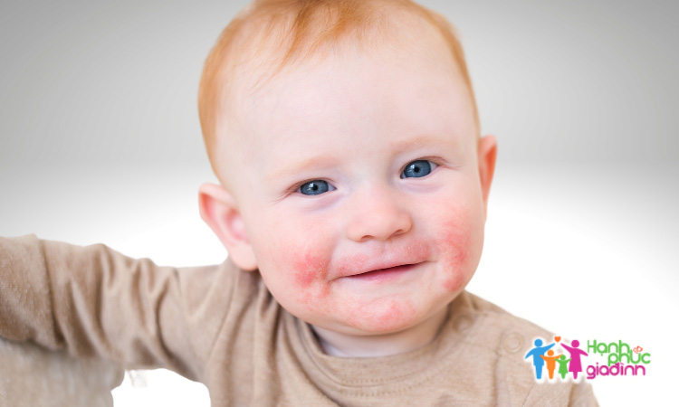 Hiểu về chàm da mặt 1 Chàm da mặt thường xảy ra với trẻ nhiều hơn