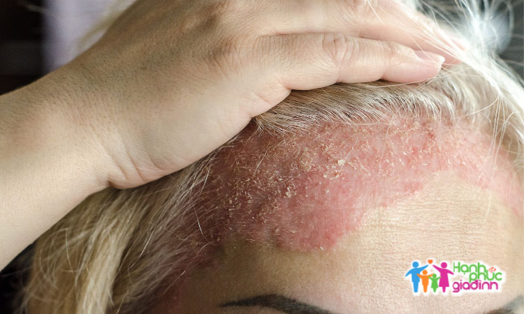 Dấu hiệu nhận biết khi bị chàm da mặt 1 Triệu chứng của chàm da mặt là những đốm đỏ khác biệt với vùng da bình thường