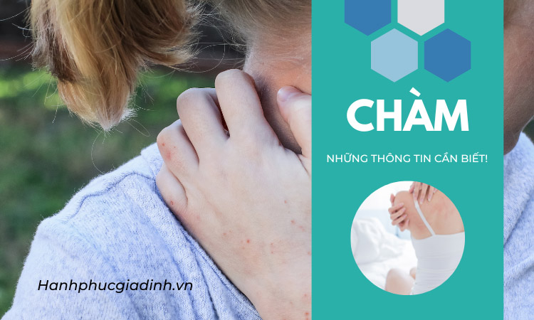 Bệnh Chàm và những điều cần biết! 1