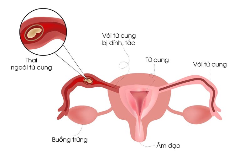 Căng tức bụng dưới khi mang thai gây nguy hiểm 1 Căng tức bụng dưới khi mang thai gây nguy hiểm 1