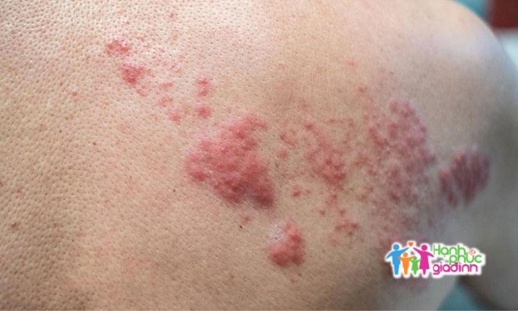 Triệu chứng chàm bội nhiễm