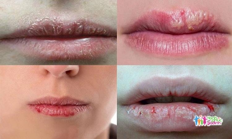 Triệu chứng chàm môi