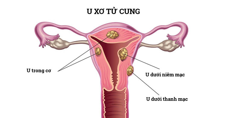 U xơ tử cung 1 U xơ tử cung 1