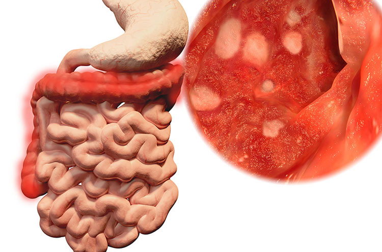 Bệnh viêm đại tràng 1