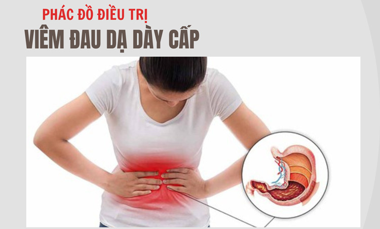 Điều trị viêm đau dạ dày cấp theo Bộ Y tế 1