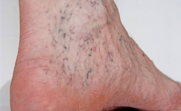 Suy giãn tĩnh mạch chân có tự khỏi được không? 1 Suy giãn tĩnh mạch chân có tự khỏi được không? 1