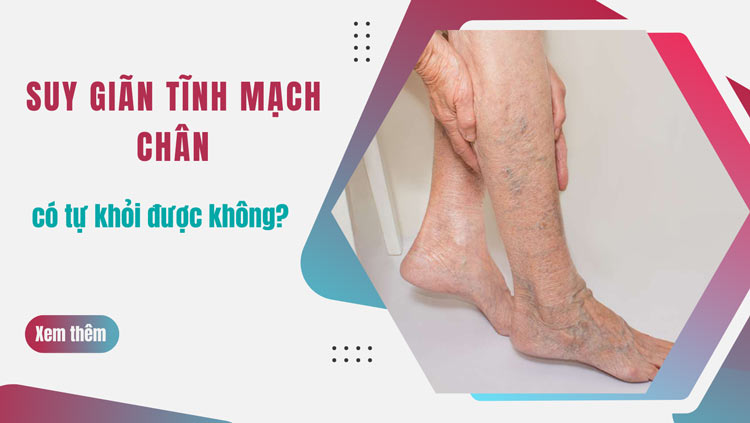 Suy giãn tĩnh mạch chân có tự khỏi được không? 1 Suy giãn tĩnh mạch chân có tự khỏi được không? 1