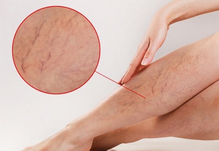 Bị suy giãn tĩnh mạch chân 1 Bị suy giãn tĩnh mạch chân 1