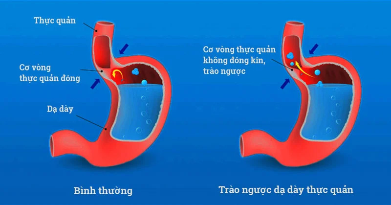 Trào ngược dạ dày thực quản 1